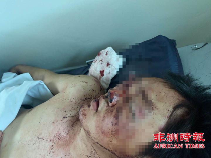 自由州省博沙贝洛黑人区一对中国夫妻遭遇抢劫重伤住院